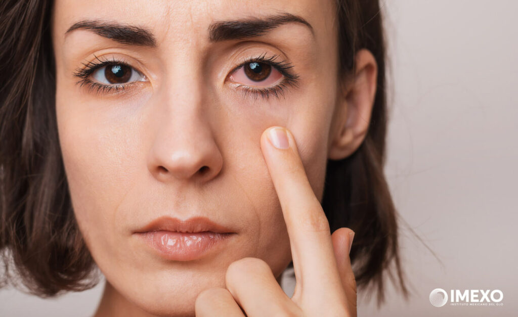 El síntoma principal del ojo seco es la sensación de sequedad ocular o irritación en los ojos.