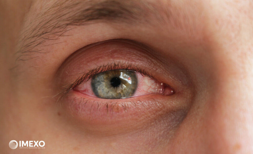 El ojo seco al despertar es una sensación molesta que afecta el bienestar en general. 