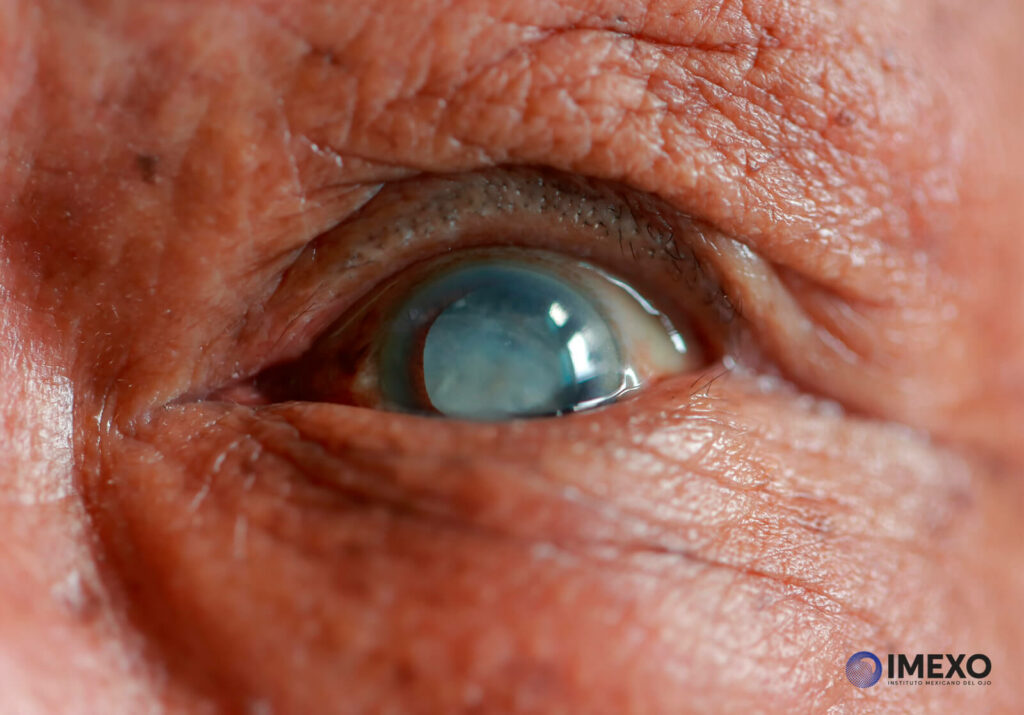 La formación de cataratas puede ser un proceso gradual relacionado con el envejecimiento del ojo. 