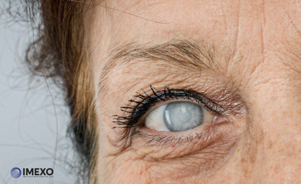 La formación de catarata a menudo forma parte del envejecimiento natural del ojo. 