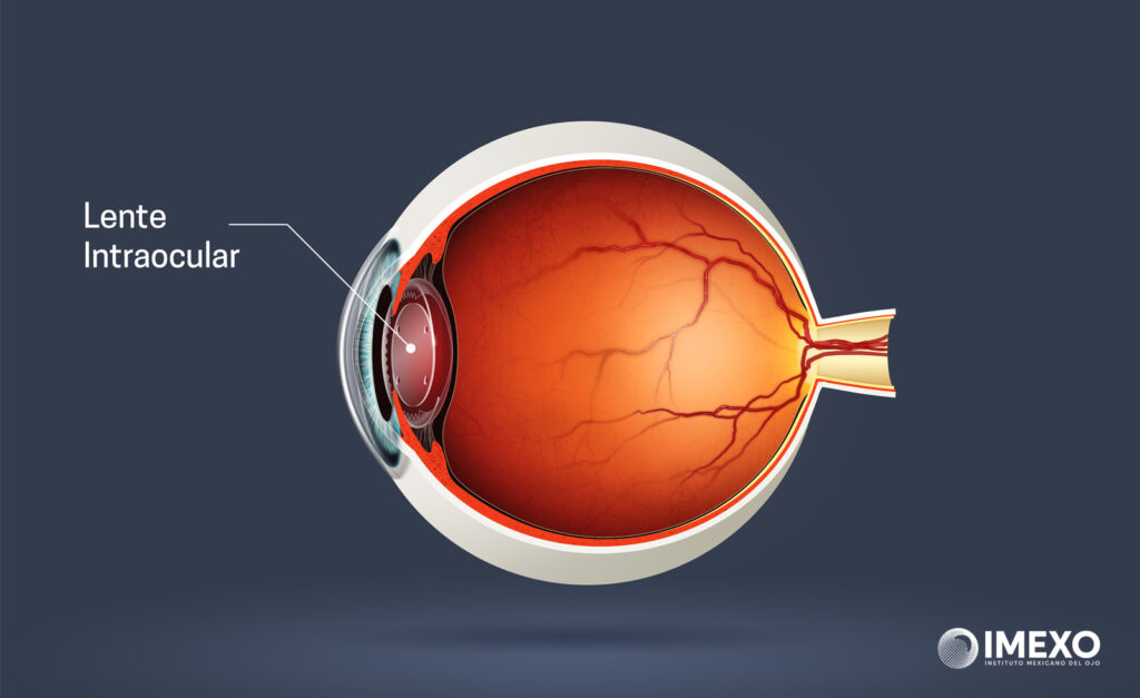 La lente intraocular reemplaza el lente natural del ojo. 