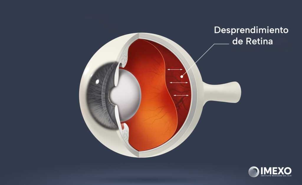 Los desprendimientos de retina son problemas oculares graves.