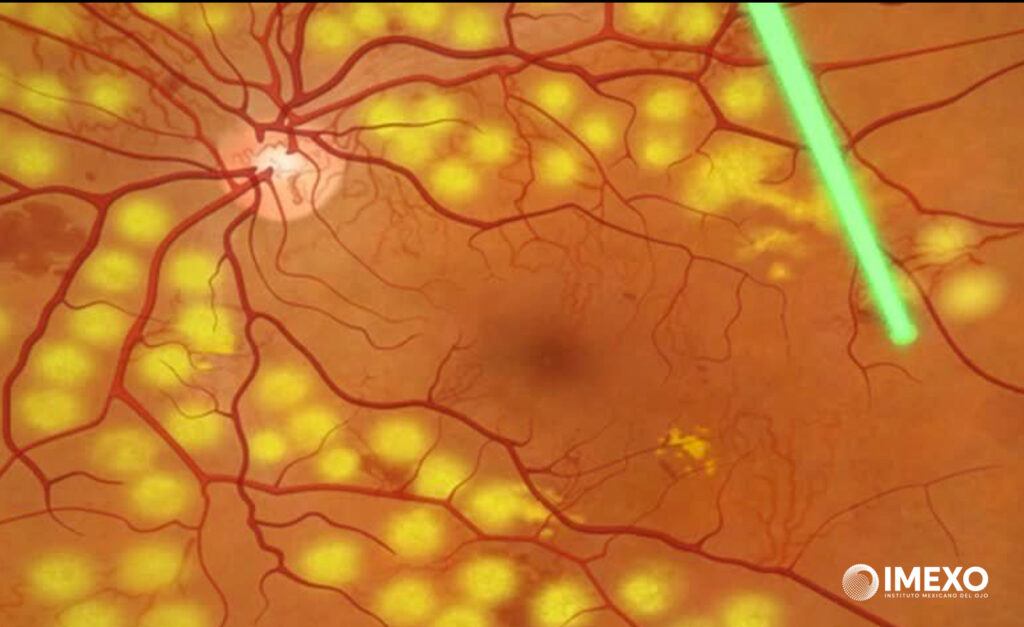La fotocoagulación con láser es una cirugía para eliminar las estructuras anormales en la retina. 
