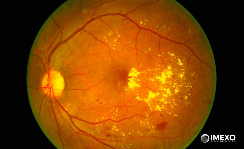 El edema macular diabético reduce la agudeza visual en las personas con diabetes. 