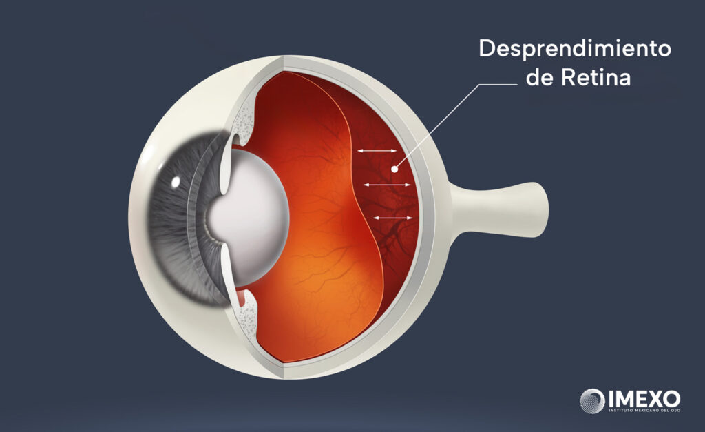 El desprendimiento de retina es un padecimiento urgente que suele asociarse con las moscas volantes. 