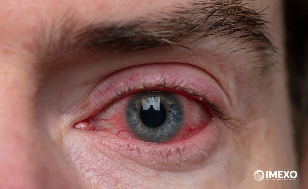 Un ojo con blefaritis normalmente se encuentra irritado.