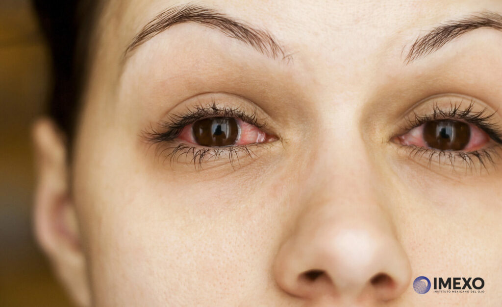 Si no se trata a tiempo el enrojecimiento de los ojos, puede llegar a ocasionar un daño permanente.