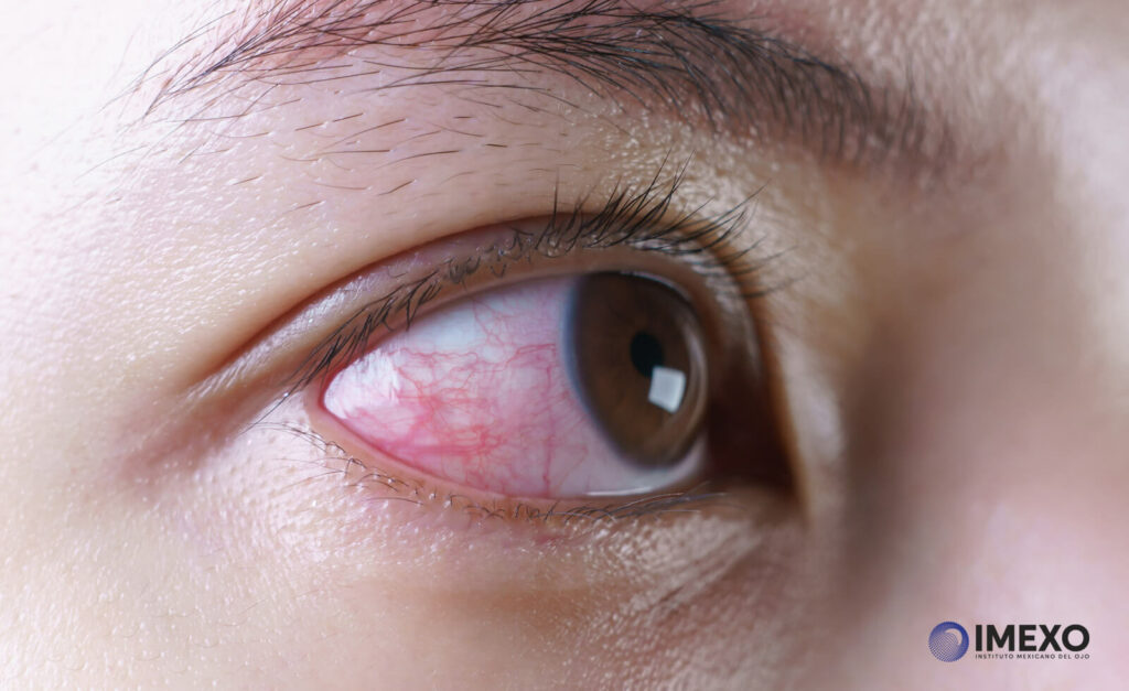 Los ojos rojos pueden ser ocasionados por fatiga ocular hasta infecciones oculares.