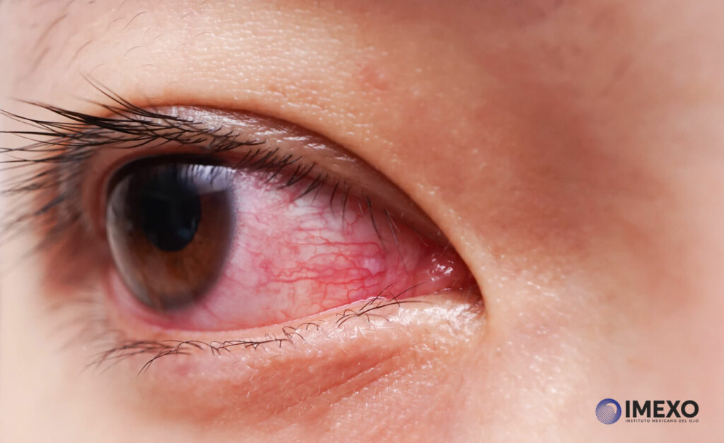 Las lagañas en gran cantidad pueden indicar una infección ocular como conjuntivitis. 