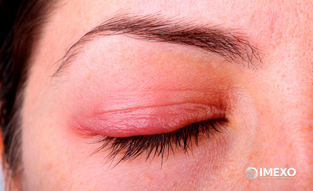 El dolor en los ojos puede ser causado por infecciones oculares. 