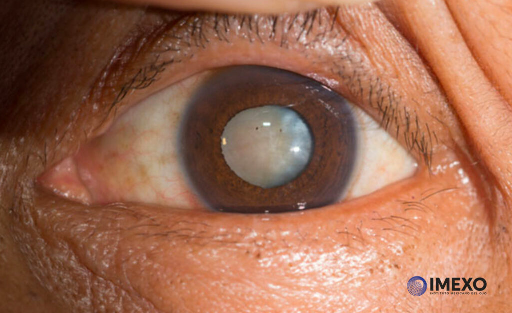 La catarata es una enfermedad que causa dificultad en la visión.