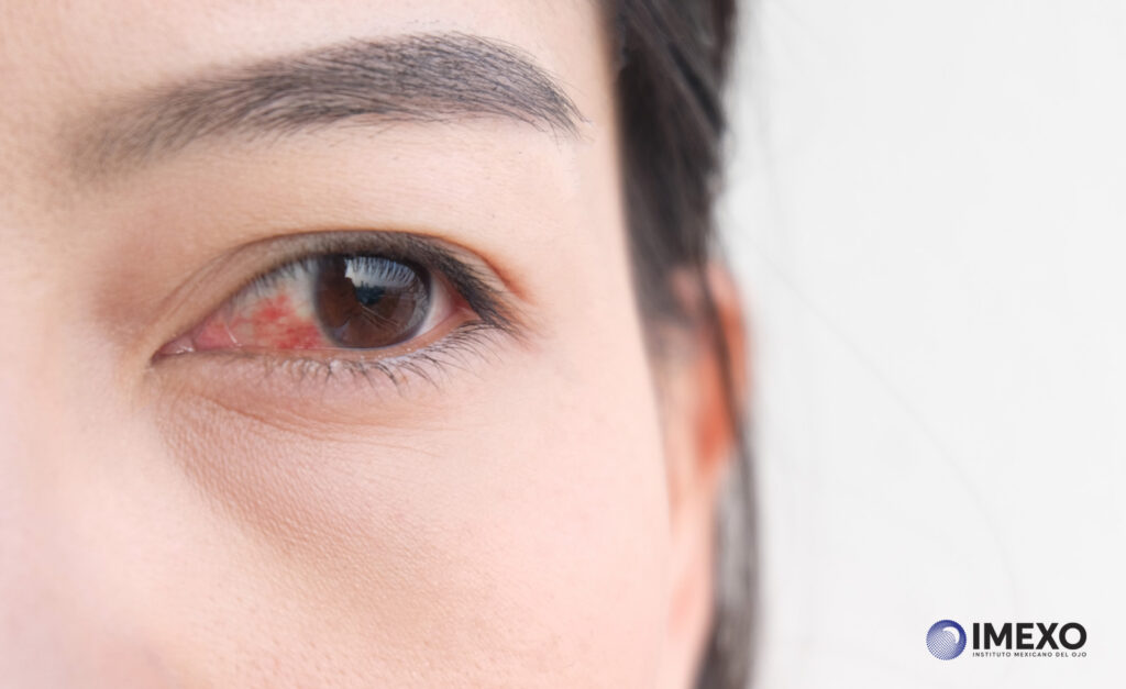 La infección en el ojo es una condición que no debe pasarse por alto.