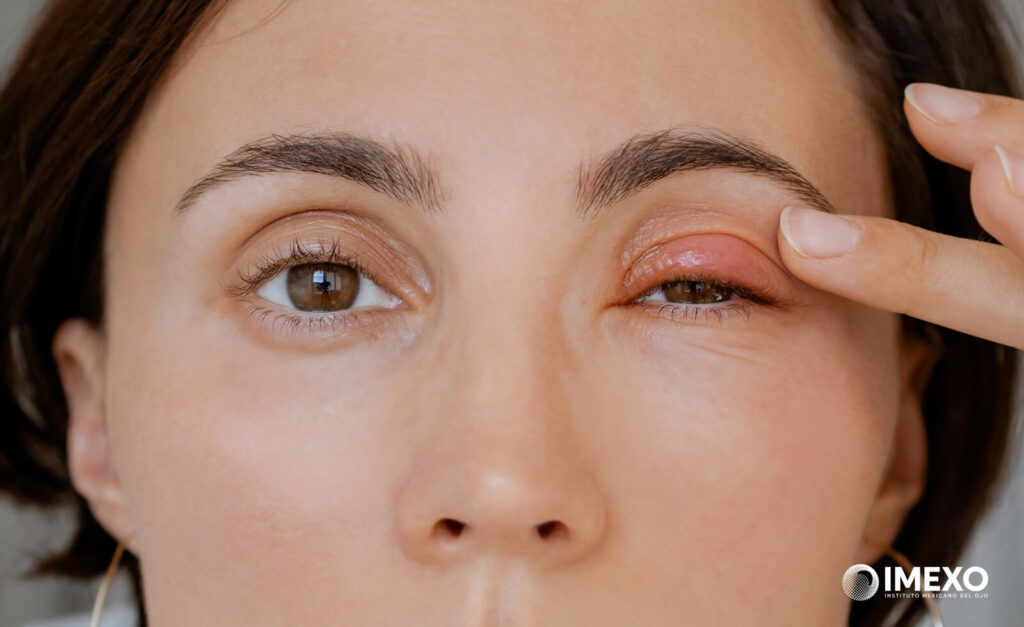 El ardor, la hinchazón y la sensibilidad a la luz son síntomas en las infecciones oculares. 